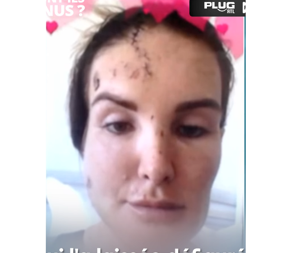 Marie Garet, ex-candidate de télé-réalité défigurée après son accident de la route en 2017.