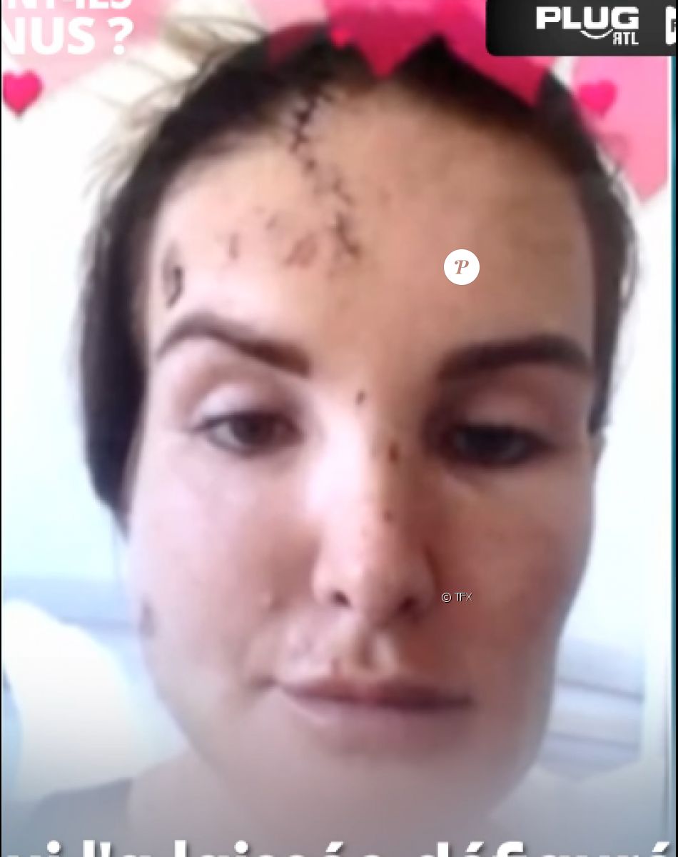 Marie Garet, ex-candidate de télé-réalité défigurée après son accident de la route en 2017.