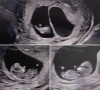 Shanna Kress annonce être enceinte de jumeaux. Le 1er mai 2022.