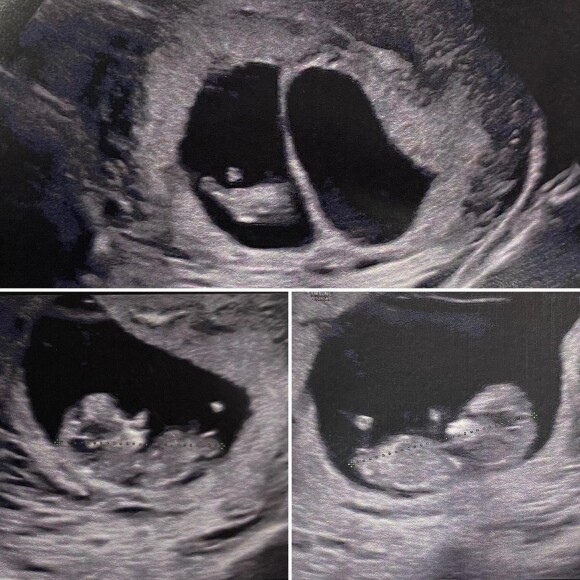 Shanna Kress annonce être enceinte de jumeaux. Le 1er mai 2022.