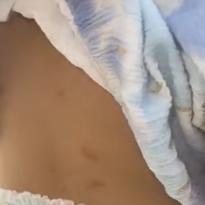 Manon Marsault dévoile des images de sa fille Angelina dévorée par les moustiques - Snapchat