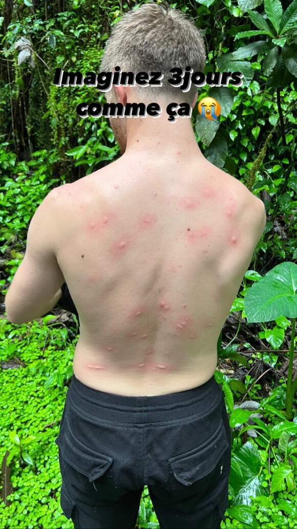 Michou dévoile son dos parsemé de piqures de moustiques - Instagram