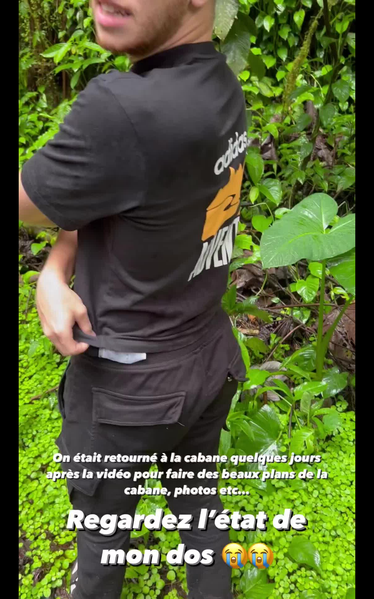 Vidéo : Michou dévoile son dos parsemé de piqures de moustiques - Instagram  - Purepeople