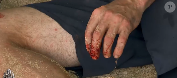 Et s'est coupé le doigt avec une machette.
Douzième épisode de "Koh-Lanta, Les Chasseurs d'immunité", mardi sur TF1.