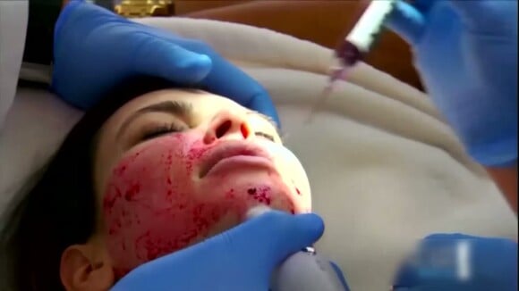 Kim Kardashian, le visage en sang : Les images de son ''lifting de vampire''