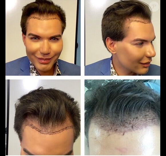 Le 32ème opération de chirurgie esthétique pour Rodrigo Alves, sur Instagram le 9 juin 2015