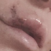 Jillian Barberie s'est fait mordre par le chien d'un ami. Elle a publié une photo de ses dix points de suture à la lèvre qui commence à cicatriser sur sa page Twitter, le 14 mars 2016.