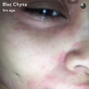 Blac Chyna a fait une réaction allergique à un soin du visage. Photo publiée sur Snapchat le 7 août 2016