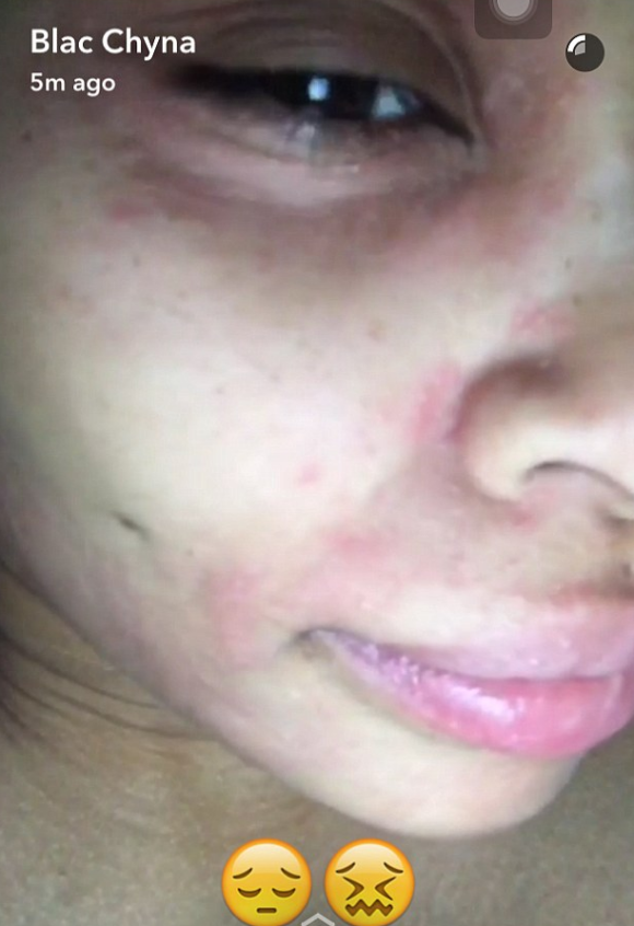 Blac Chyna a fait une réaction allergique à un soin du visage. Photo publiée sur Snapchat le 7 août 2016