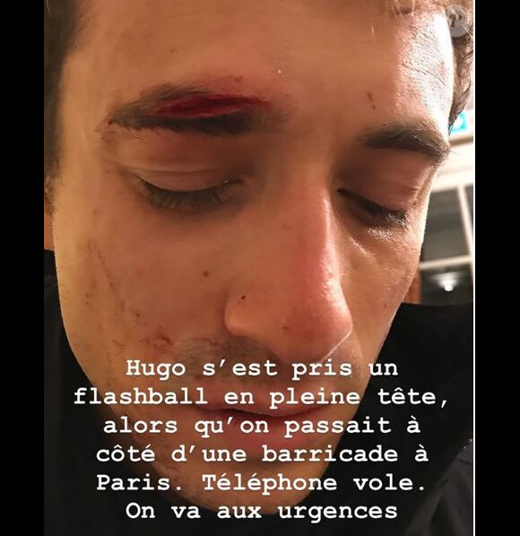 Hugo Clément blessé dans les manifestations des Gilets jaunes à Paris le 1er décembre 2018, photo publiée par sa compagne Alexandra Rosenfeld sur son compte Instagram.