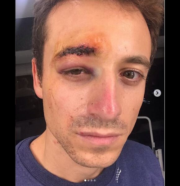 Hugo Clément a été blessé dans les manifestations des Gilets jaunes à Paris le 1er décembre 2018, photo publiée après son passage par les urgences de l'hôpital Bichat sur le compte Instagram de sa compagne Alexandra Rosenfeld. Hugo s'était fait voler son téléphone et n'avait plus accès à ses comptes.