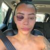Yasmine Pierards des "Princes de l'amour" agressée lors d'une soirée, les photos choc' dévoilées le 11 août 2020, sur Instagram