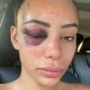 Yasmine Pierards des "Princes de l'amour" agressée lors d'une soirée, les photos choc' dévoilées le 11 août 2020, sur Instagram