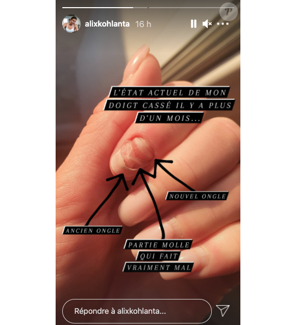 Alix Noblat, célèbre candidate de Koh-Lanta, Les 4 Terres (2020) dévoile son horrible blessure au doigt sur Instagram.