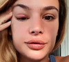 Jade Leboeuf dévoile son oeil très gonflé sur Instagram - 14 janvier 2021