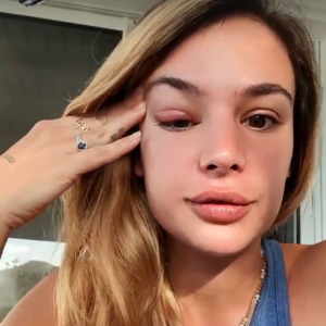 Jade Leboeuf dévoile son oeil très gonflé sur Instagram - 14 janvier 2021