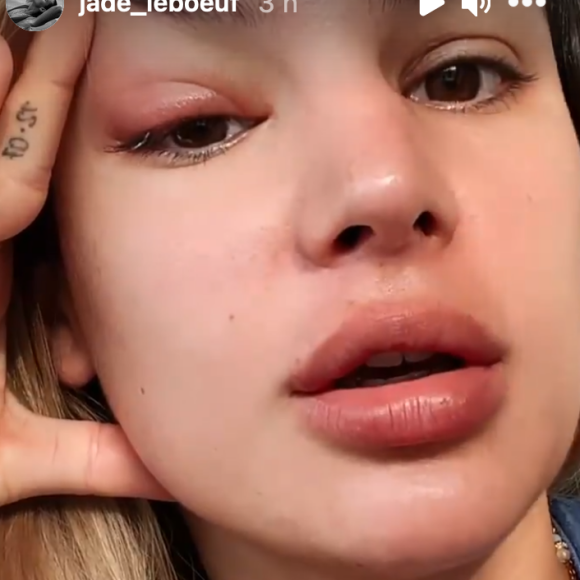 Jade Leboeuf dévoile son oeil très gonflé sur Instagram - 14 janvier 2021