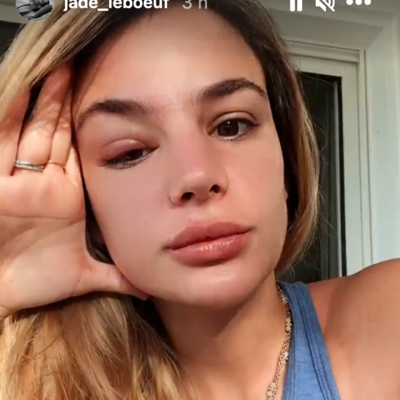 Jade Leboeuf dévoile son oeil très gonflé sur Instagram - 14 janvier 2021