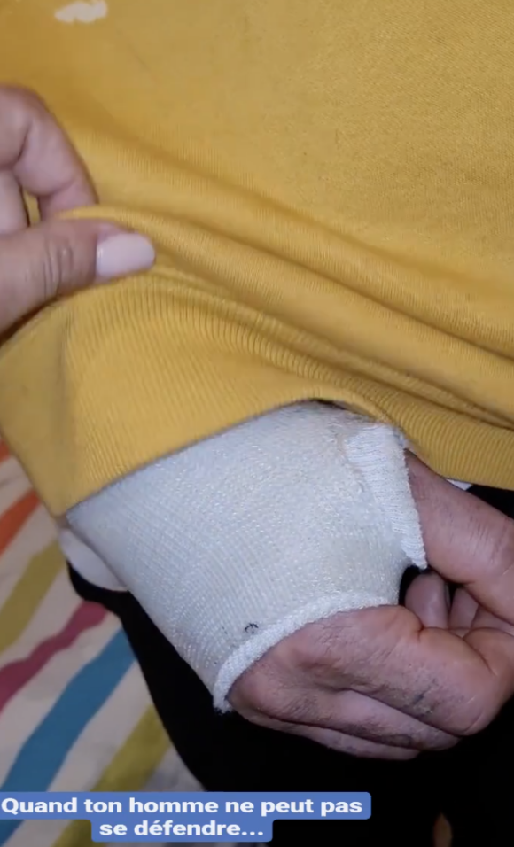 Thomas (Koh-Lanta) s'affiche le bras dans le plâtre sur Instagram après un accident
