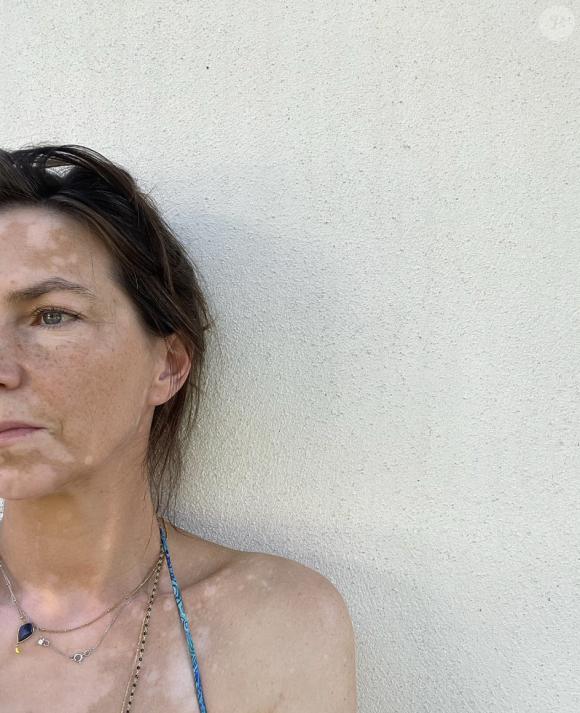 Sur l'image, la jolie brune se révèle adossée à un mur, le regard fuyant l'objectif. Impossible alors de passer à côté des zones de dépigmentation qui occupent son visage, son coup et son torse.
Carole Bianic (Demain nous appartient) partage une photo d'elle et révèle être atteinte de la maladie de vitiligo, laquelle a pris de l'ampleur. Instagram