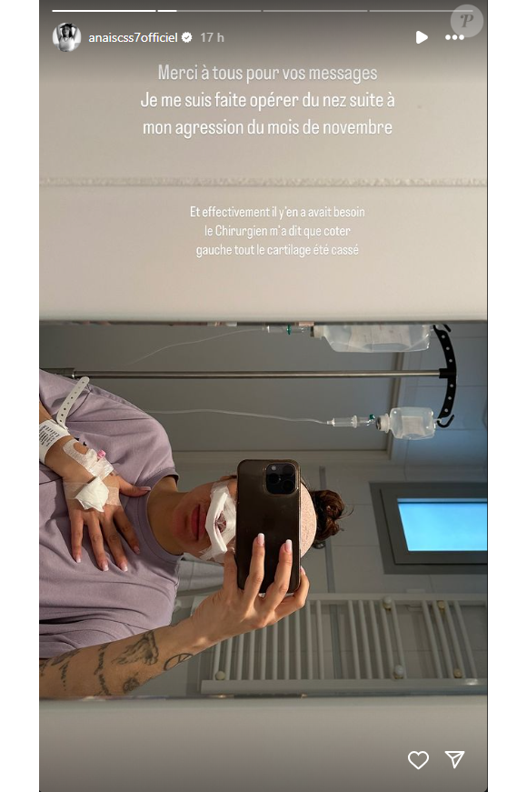 Une opération du nez qui fait suite à son agression survenue en novembre 2023.
Anaïs Camizuli a subi une opération du nez suite à sa violente agression survenue en novembre 2023. Instagram