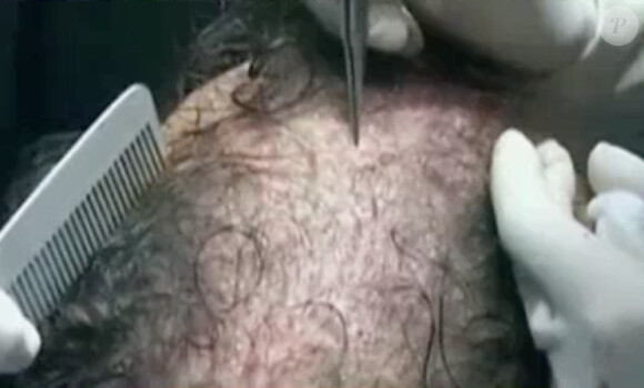 Julien Lepers découvre une vidéo filmée pendant qu'il se faisait implanter des cheveux. Emission "Salut les terriens !" du samedi 5 avril 2014.