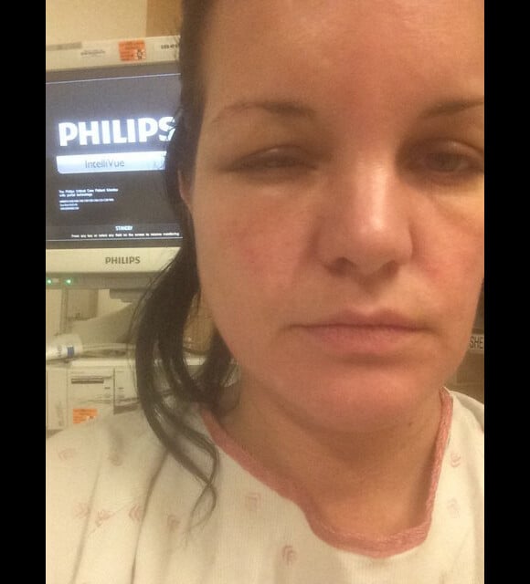 Pauley Perrette, défigurée par une allergie à sa teinture, image publiée sur son compte Twitter le 19 juillet 2014