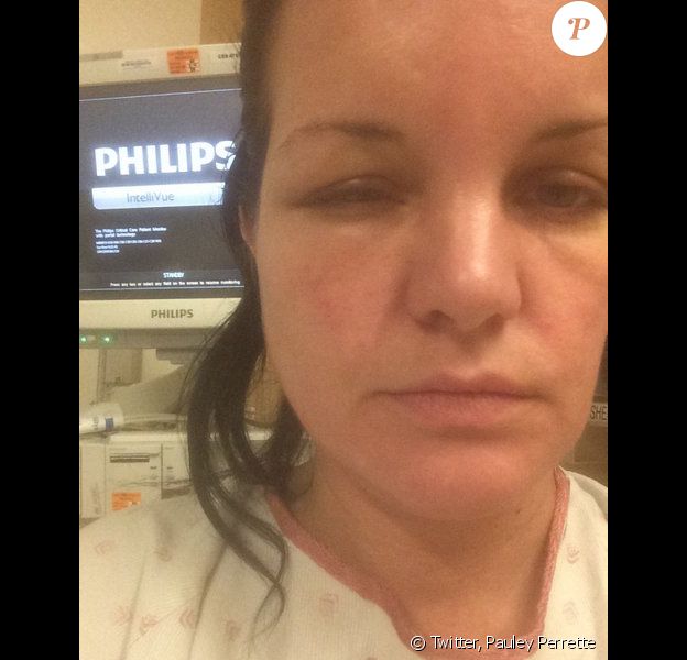 Pauley Perrette, défigurée par une allergie à sa teinture, image publiée sur son compte Twitter le 19 juillet 2014