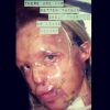 Katie Piper a posté une photo de son visage après son agression à l'acide