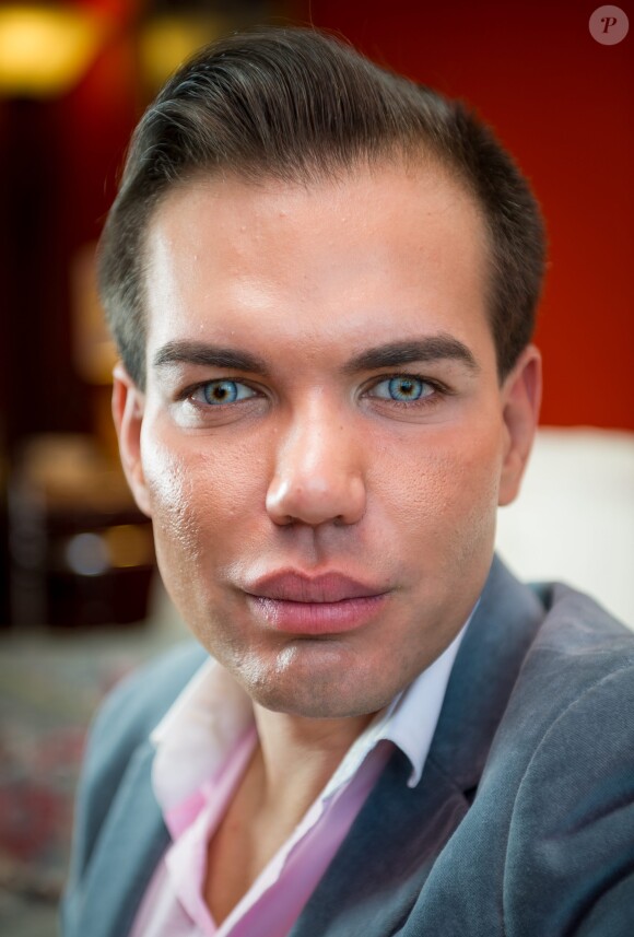 Le brésilien Rodrigo Alves âgé de seulement 31 ans a déjà subi plus d'une trentaine d'opérations de chirurgie esthétique. De nombreux actes médicaux qui ont failli lui coûter la vie puisqu'il est déjà resté paralysé et incapable de se nourrir ou de se laver. Toutefois il jure pour l'instant de ne jamais s'arrêter. 