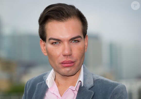 Le brésilien Rodrigo Alves âgé de seulement 31 ans a déjà subi plus d'une trentaine d'opérations de chirurgie esthétique. De nombreux actes médicaux qui ont failli lui coûter la vie puisqu'il est déjà resté paralysé et incapable de se nourrir ou de se laver. Toutefois il jure pour l'instant de ne jamais s'arrêter.