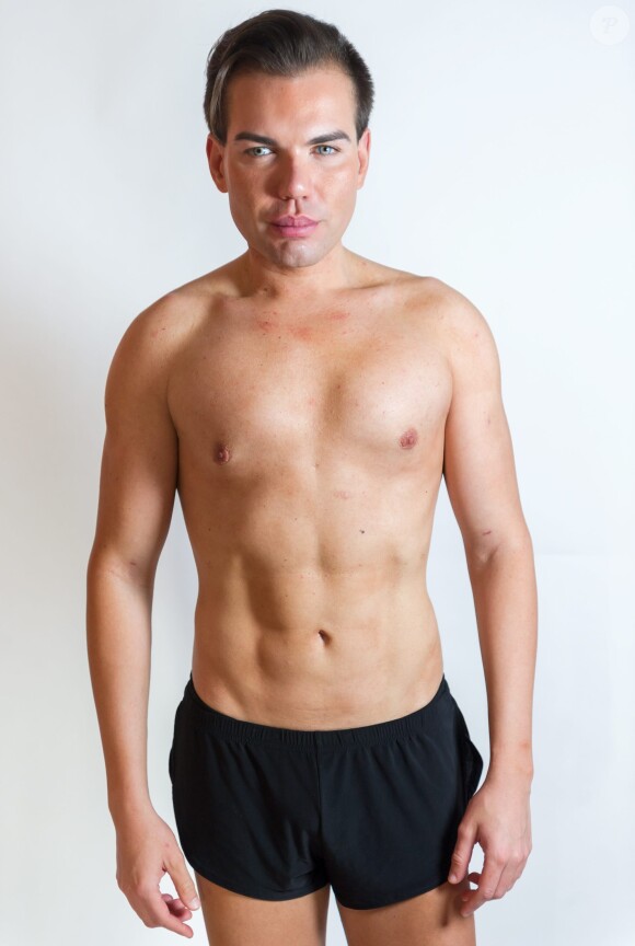 Le brésilien Rodrigo Alves âgé de seulement 31 ans a déjà subi plus d'une trentaine d'opérations de chirurgie esthétique. De nombreux actes médicaux qui ont failli lui coûter la vie puisqu'il est déjà resté paralysé et incapable de se nourrir ou de se laver. Toutefois il jure pour l'instant de ne jamais s'arrêter.