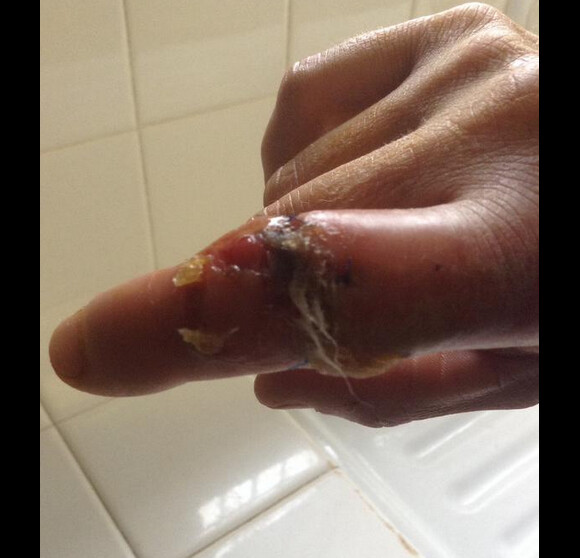 Chanta de Koh-Lanta 2015 dévoile sa grave blessure au doigt. Juin 2015