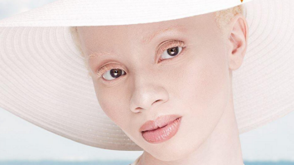 Thando Hopa : Albinos et mannequin star, elle rayonne sur la modosphère