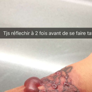 Caroline Receveur se fait retirer certains tatouages. Des images choc !