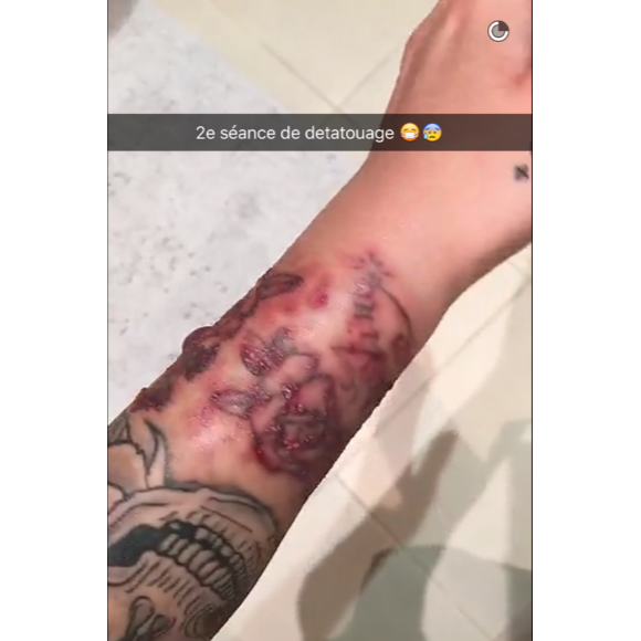 Caroline Receveur se fait retirer certains tatouages. Deuxième séance de laser !