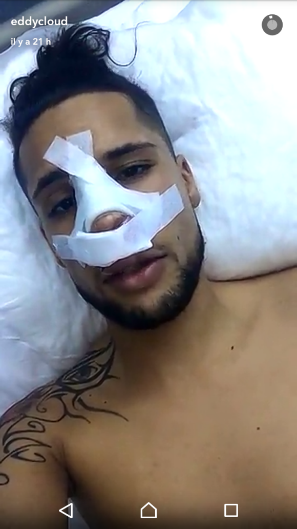 Eddy dévoile ses bandages après son opération de chirurgie, Snapchat, mars 2017