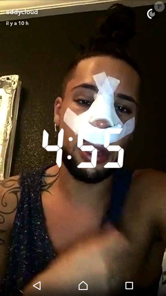 Eddy se dévoile après son opération de chirurgie, Snapchat, mars 2017