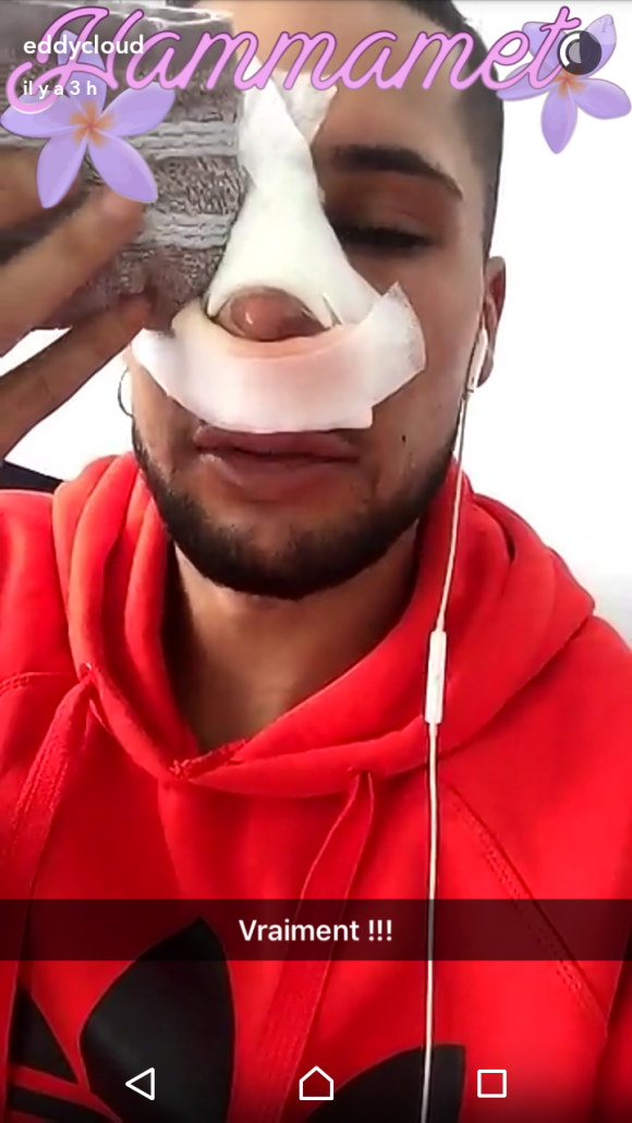 Eddy déprimé après son opération de chirurgie, Snapchat, mars 2017