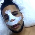 Eddy dévoile ses bandages après son opération de chirurgie, Snapchat, mars 2017