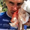 Yoann Offredo en sang après une violente agression.