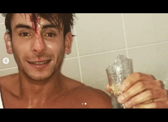 Alexandre de "Koh-Lanta" blessé lors d'une soirée avec Brice - Instagram, le 20 juin 2019