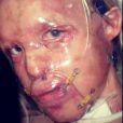 Katie Piper a posté une photo de son visage après son agression à l'acide en 2008. 
