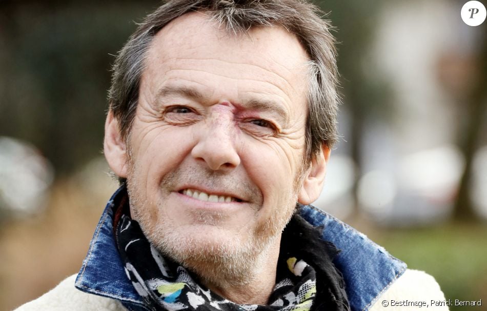 Jean Luc Reichmann Tache De Vin Jean-Luc Reichmann obligé de camoufler sa tache de vin au début des Z