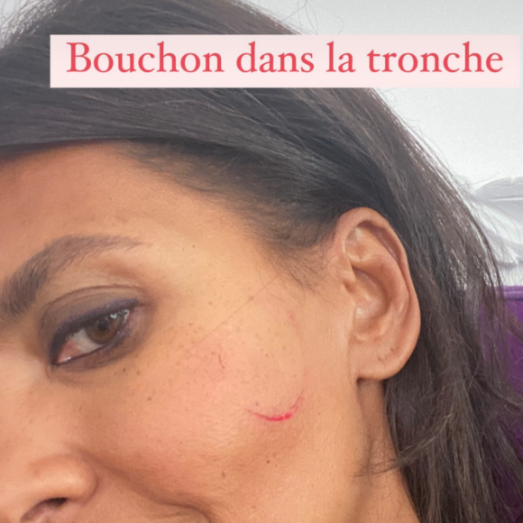 Karine Le Marchand blessée au visage