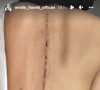 Emilie Fiorelli révèle avoir été opérée de la colonne vertébrale et dévoile une énorme cicatrice - Instagram