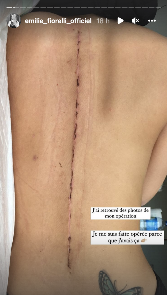 Emilie Fiorelli révèle avoir été opérée de la colonne vertébrale et dévoile une énorme cicatrice - Instagram