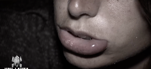 Ambre a été piquée, sa lèvre a gonflé dans "Koh-Lanta, Le Totem maudit" sur TF1.