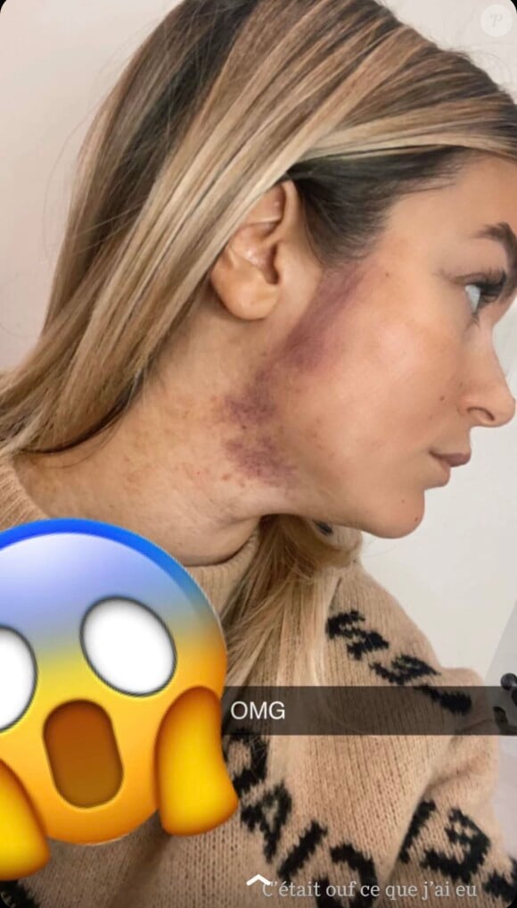 Sur Snapchat, elle apparaissait complètement tuméfiée.
Carla Moreau dévoile son visage tuméfié.