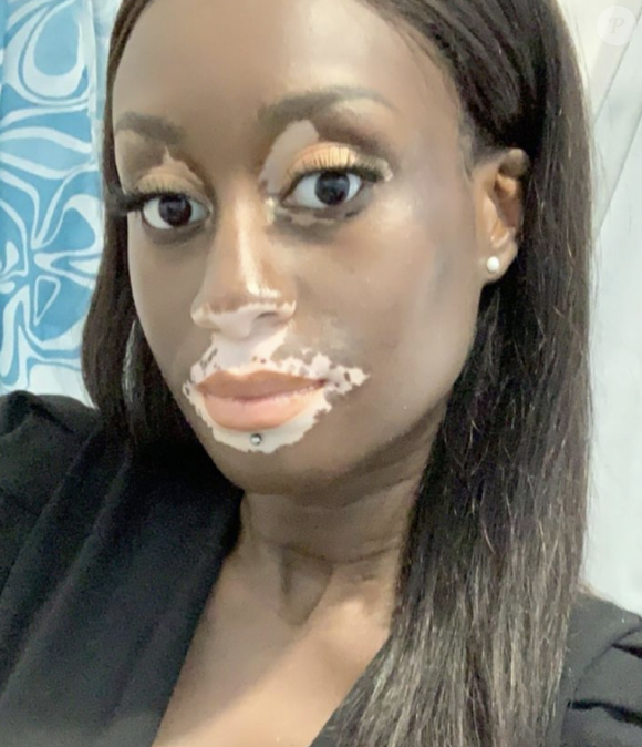 Estelle Mendy, candidate à l'élection Miss Normandie 2023, est atteinte de vitiligo. Instagram